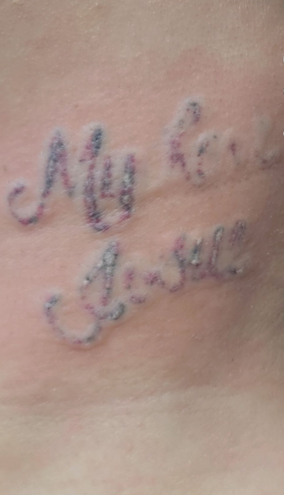 Laser Treatments