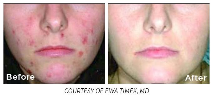 Laser Treatments