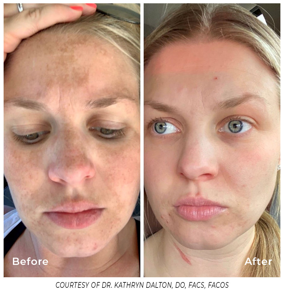 Laser Treatments