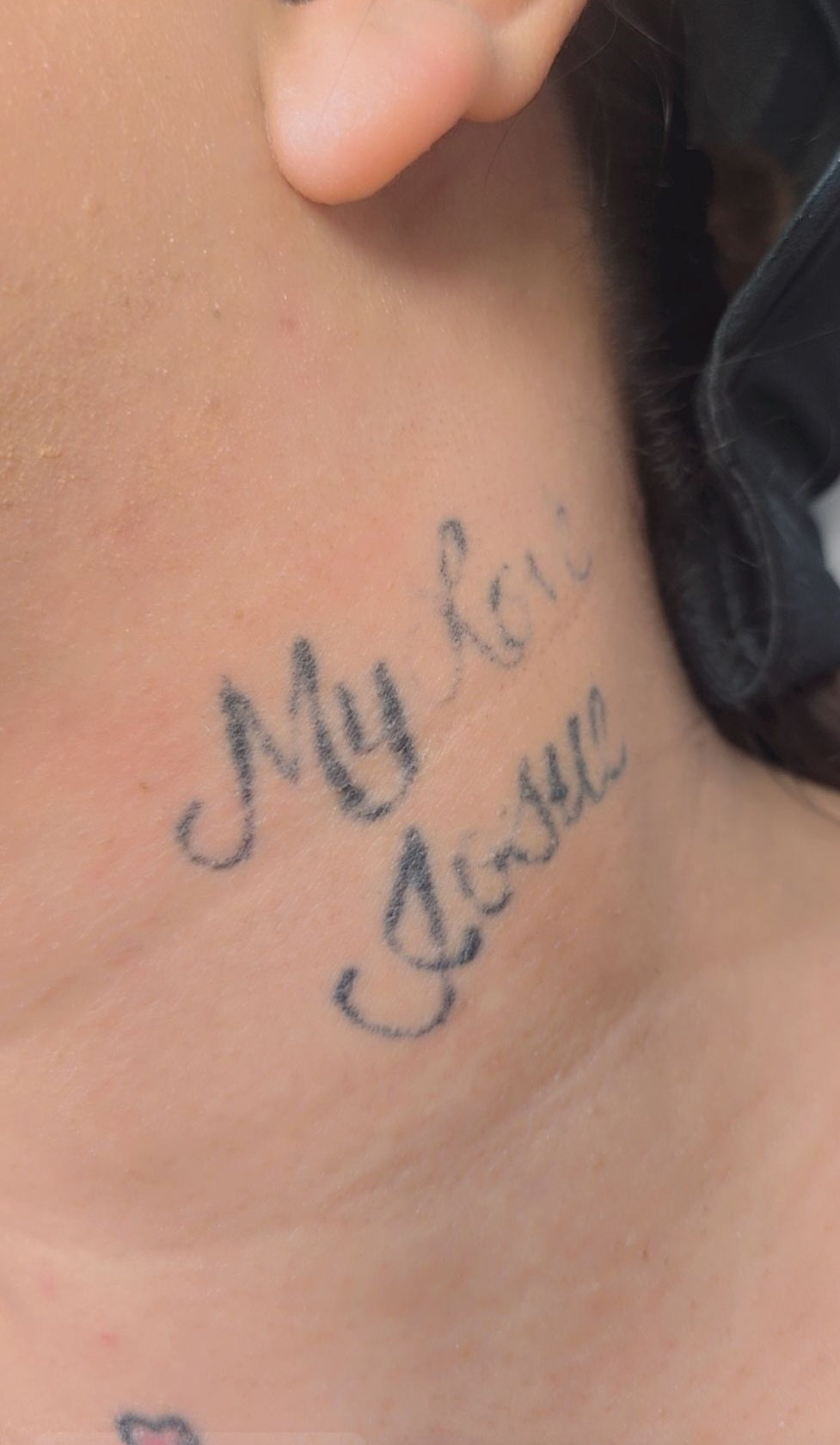 Laser Treatments